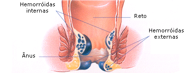 tratamento-de-hemorroidas1