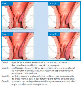 tratamento-de-hemorroidas2