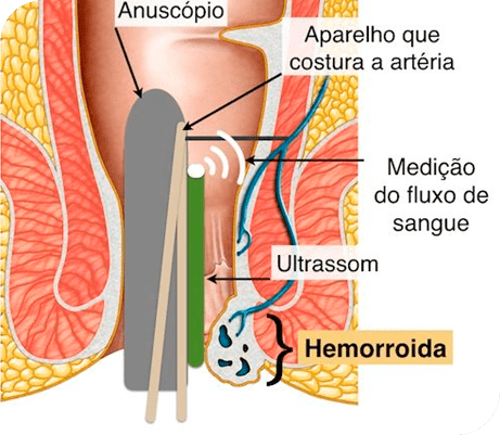 tratamento-de-hemorroidas3