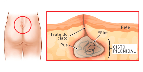 cisto-pilonidal