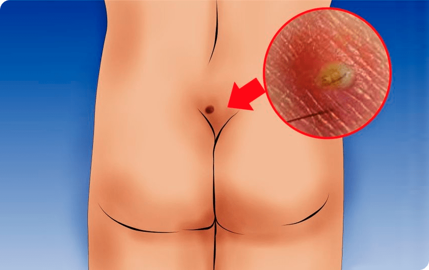 Cisto pilonidal: o que é, sintomas e cirurgia