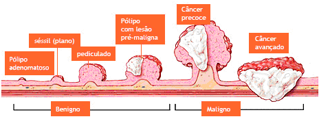 colonoscopia1