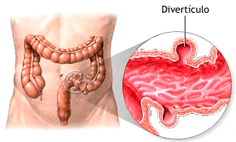 doenca-diverticular1