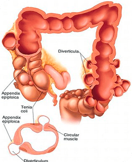 doenca-diverticular2