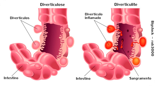 doenca-diverticular3