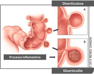 doenca-diverticular4