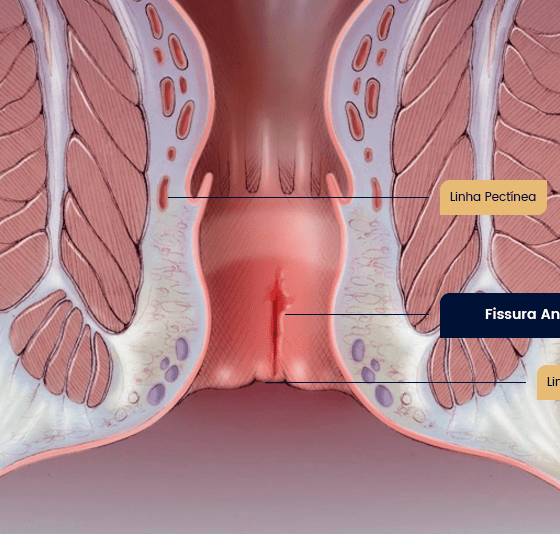 fissura-anal-final