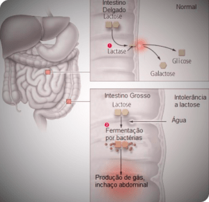 intolerancia-a-lactose1
