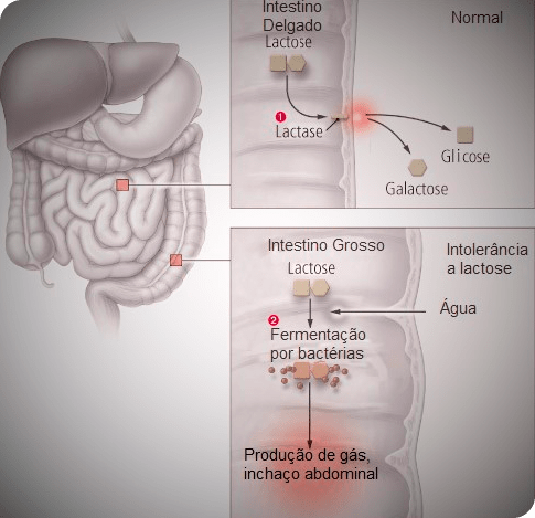 intolerancia-a-lactose1