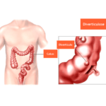 diverticulose-colonica-2