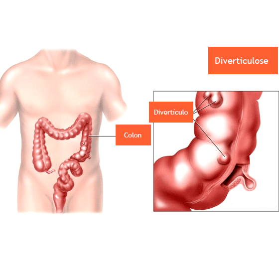 diverticulose-colonica-2