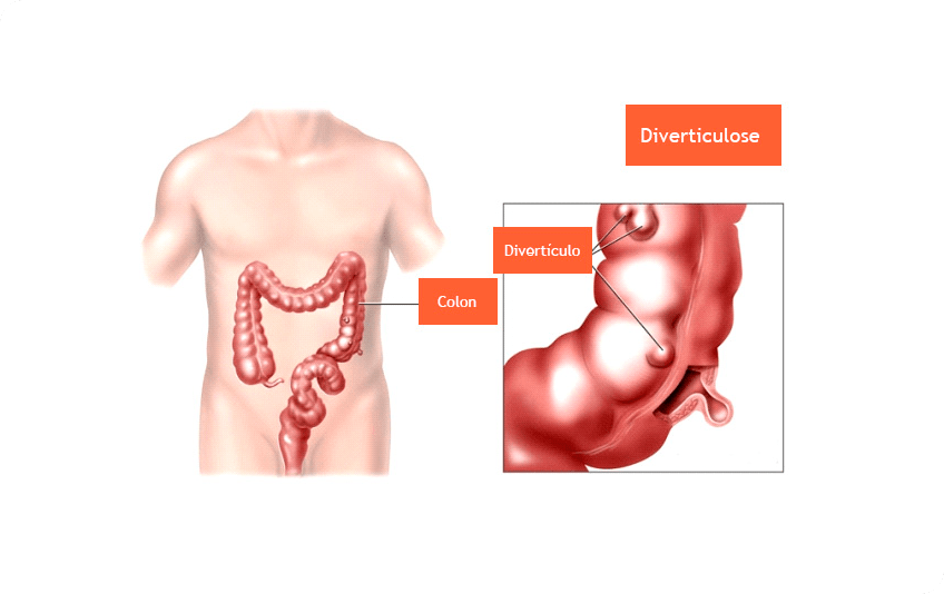 diverticulose-colonica-2